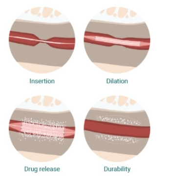 What Is Optilume® and How Is It Used?