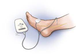 Posterior Tibial Nerve Stimulation (PTNS)