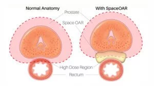 SpaceOAR™ Hydrogel