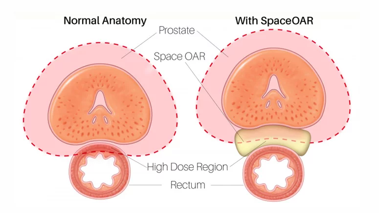 SpaceOAR™ Hydrogel